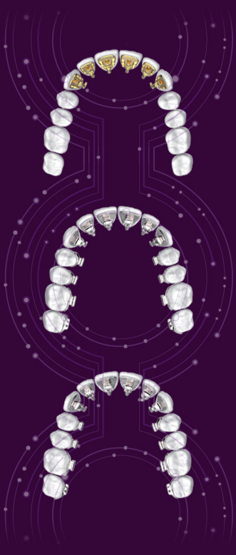 брекеты eBrace