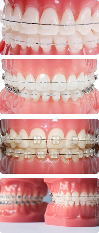 Сапфировые брекеты