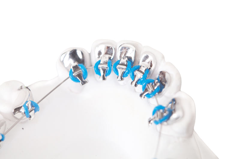 брекеты eBrace