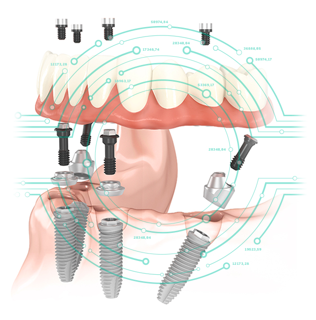 имплантация Тотал Дентал