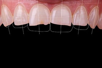 Голливудские виниры