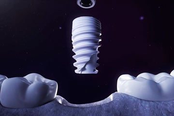 Высокоточная имплантация