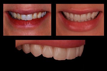 Эстетические реставрации