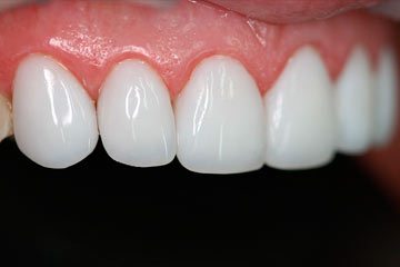 Быстрое лечение десен